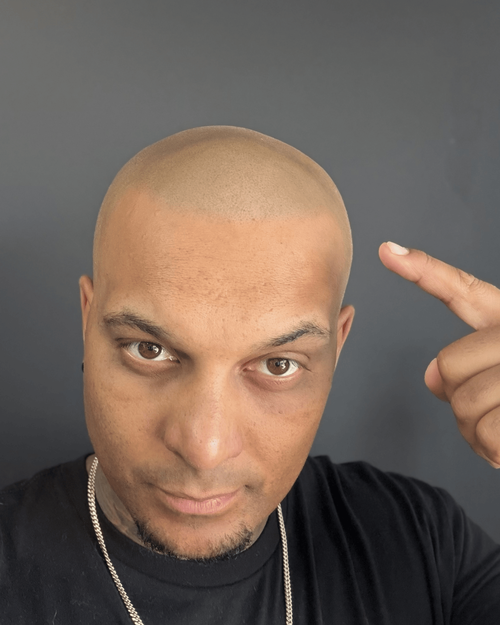 Scalp micropigmentation consultation at Modern Pigment SMP